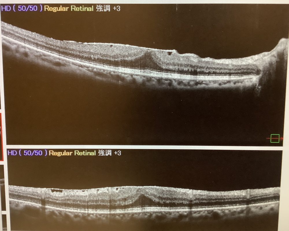 後からする黄斑上膜手術 - たまプラーザやまぐち眼科