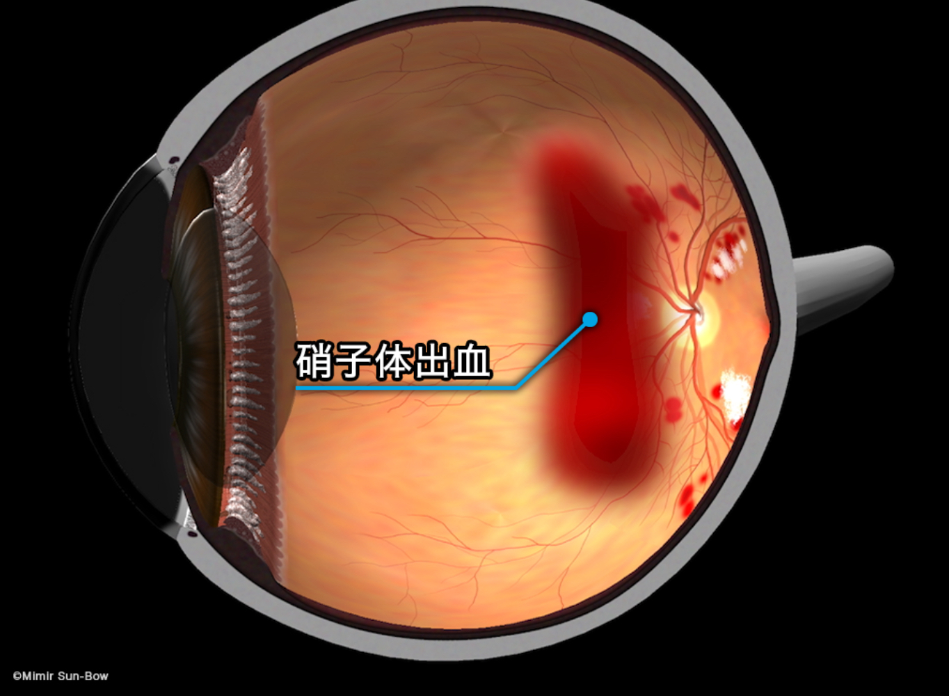 硝子体出血の原因 - たまプラーザやまぐち眼科